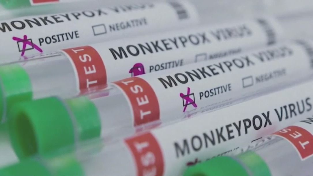 Florida's first child monkeypox case reported